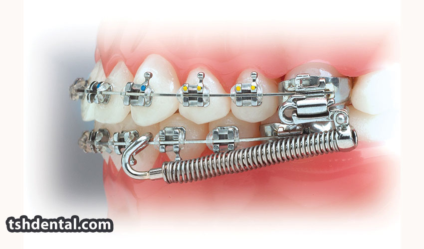 فنر باز و بسته ارتودنسی چیست ؟ 2 فنر باز و بسته ارتودنسی