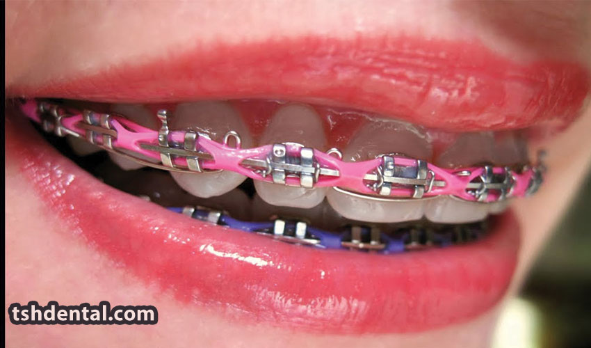 پاورچین ارتودنسی