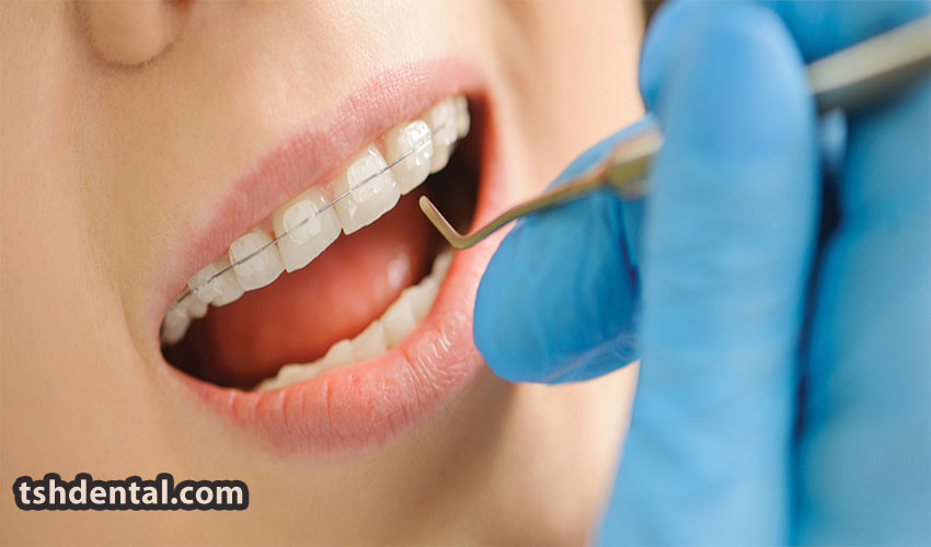 براکت سرامیکی چیست ؟ و مزایا و معایب آن 2 براکت سرامیکی