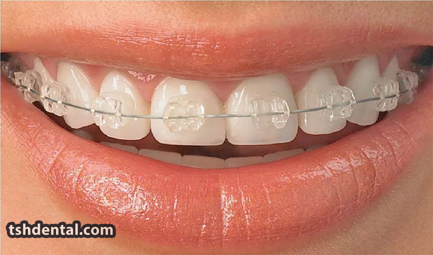 براکت سرامیکی