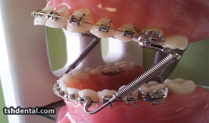 فنر باز و بسته ارتودنسی