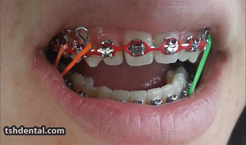 پاورچین ارتودنسی