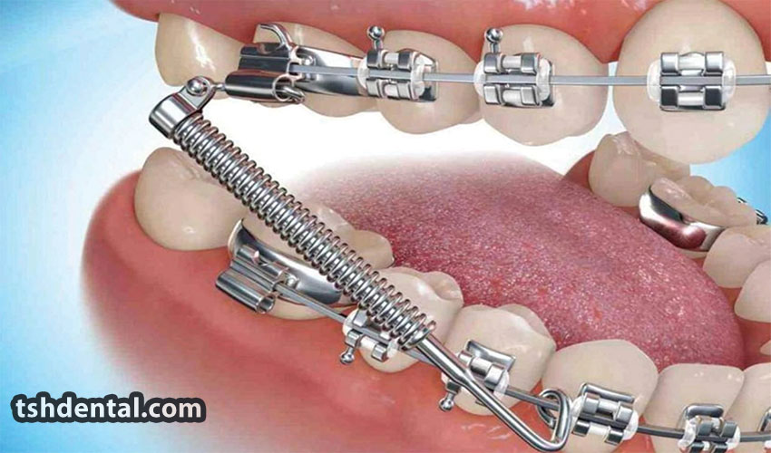 فنر باز و بسته ارتودنسی چیست ؟ 1 فنر باز و بسته ارتودنسی