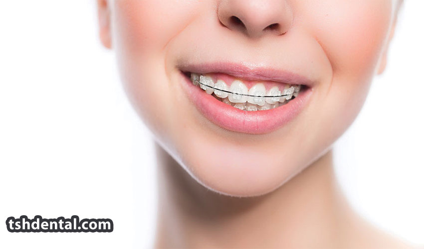 براکت سرامیکی چیست ؟ و مزایا و معایب آن 1 براکت سرامیکی