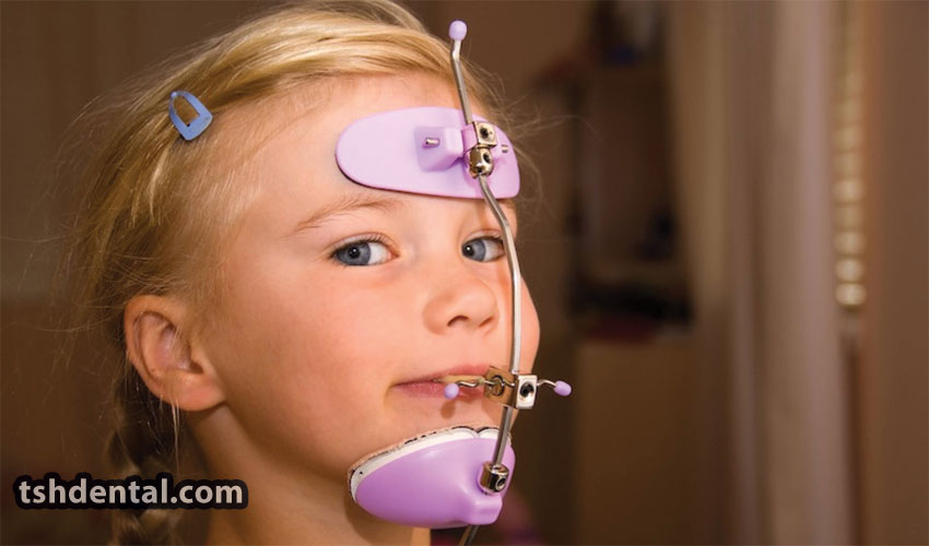 فیس ماسک ارتودنسی