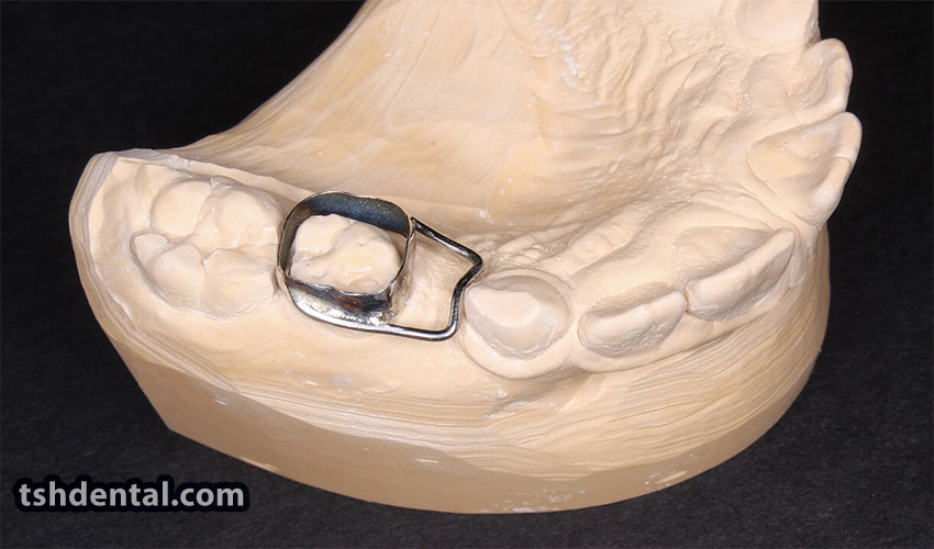 بند فضا نگهدارنده اطفال چیست؟ 2 بند فضا نگهدارنده اطفال