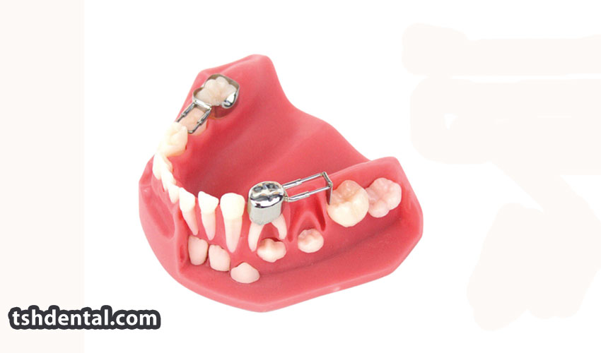 بند فضا نگهدارنده اطفال چیست؟ 1 بند فضا نگهدارنده اطفال