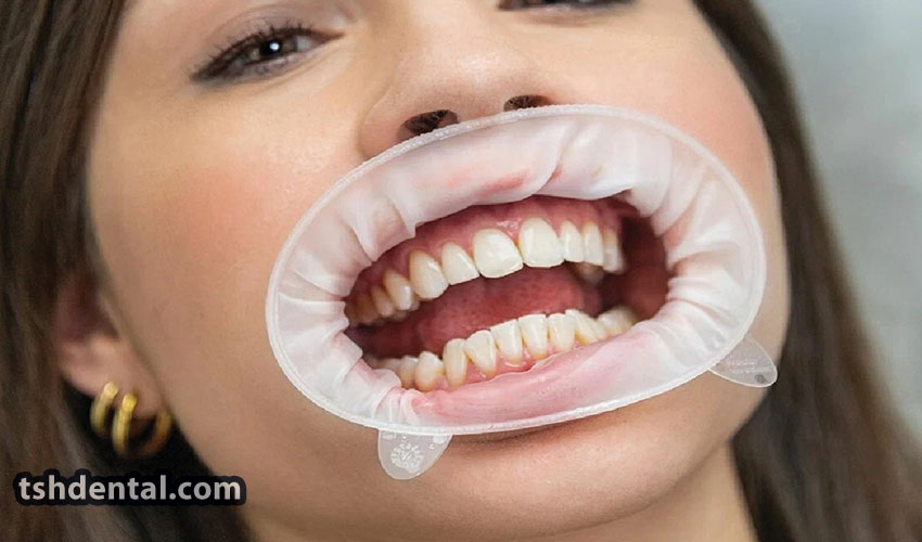 دهان باز کن