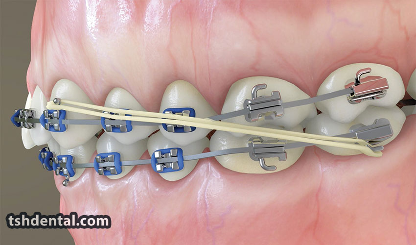 هوک ارتودنسی