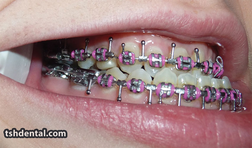 هوک ارتودنسی