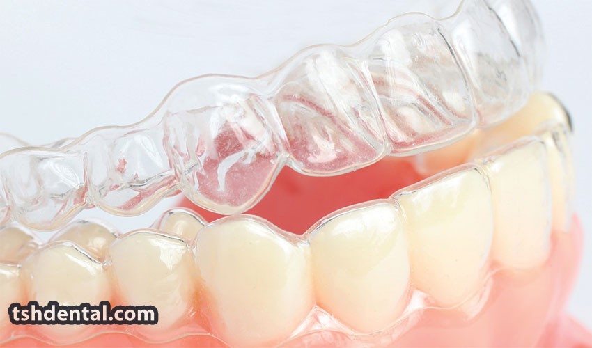 شیت ارتودنسی