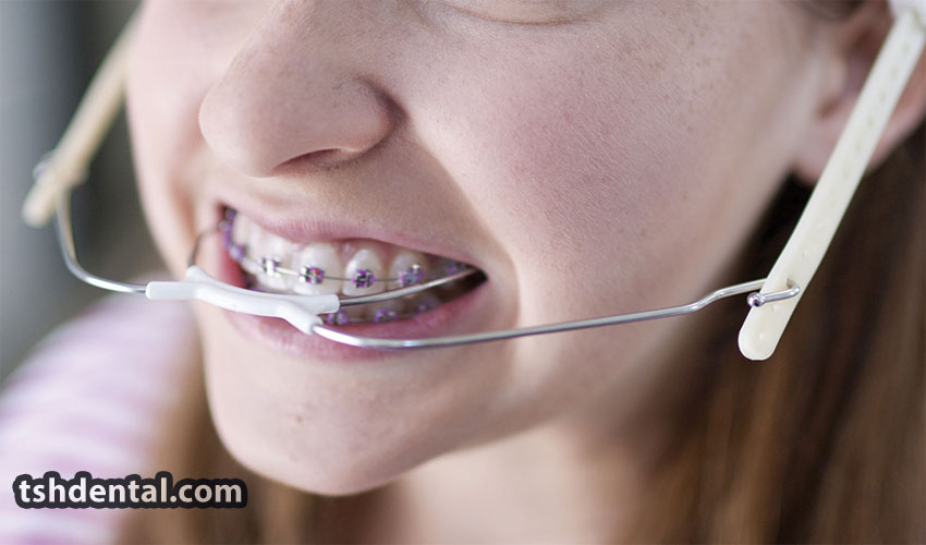 فیس بو ارتودنسی چیست ؟ 2 فیس بو ارتودنسی