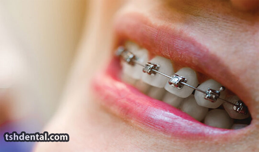 براکت سلف لیگیت