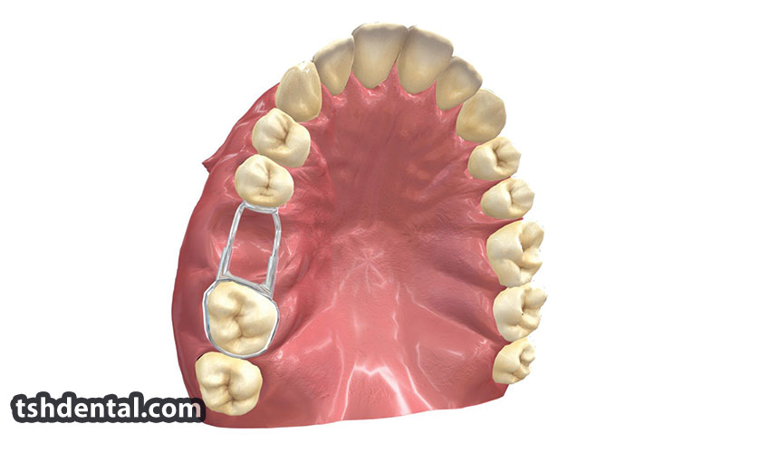 بند فضا نگهدارنده اطفال