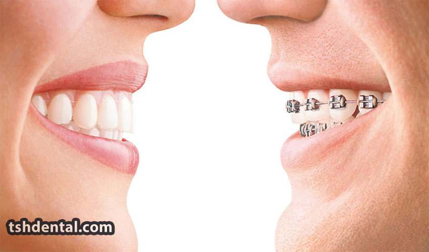 براکت سلف لیگیت چیست؟ 2 براکت سلف لیگیت