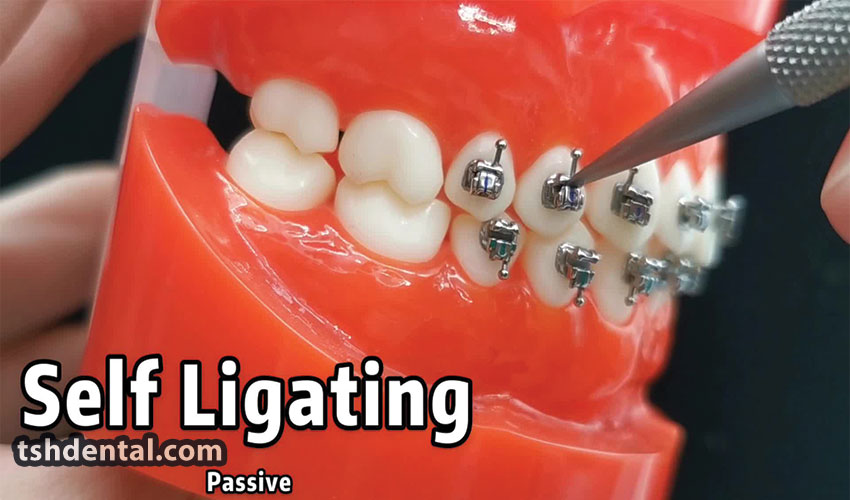 براکت سلف لیگیت چیست؟ 1 براکت سلف لیگیت